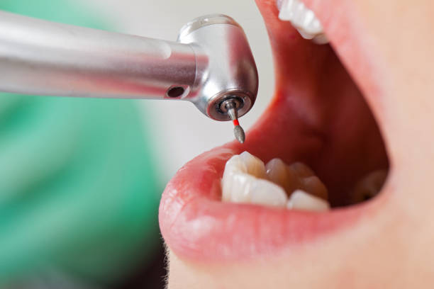 Best Emergency Dental Care for Abscessed Tooth in Elkhorn, CA